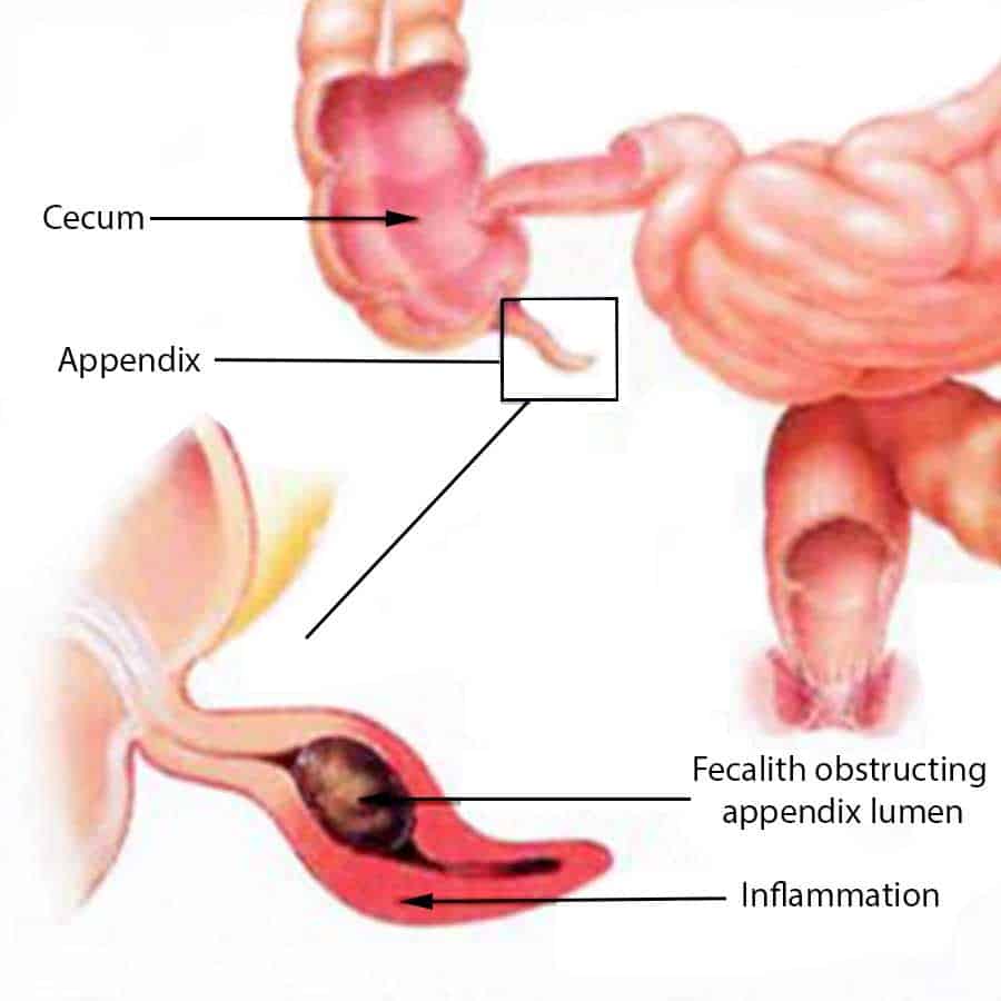 appendix is obstruction of its lumen