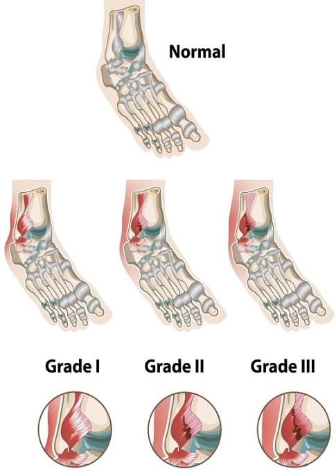 Ankle Sprain Symptoms 3 Grade Classification Treatmen - vrogue.co