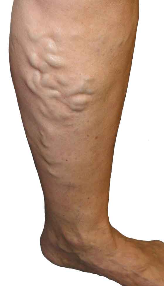 Varicose veins MedFog