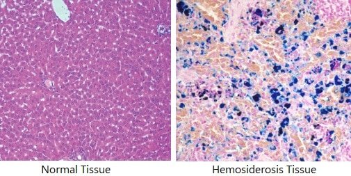 hemosiderosis tissue MedFog