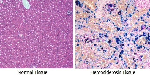 What Is Hemosiderin Staining How To Get Rid Of Hemosiderin Staining 