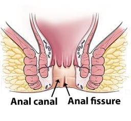 Anal-fissure-Image