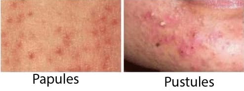 Papules and Pustules