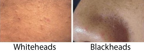 Whiteheads and Blackheads