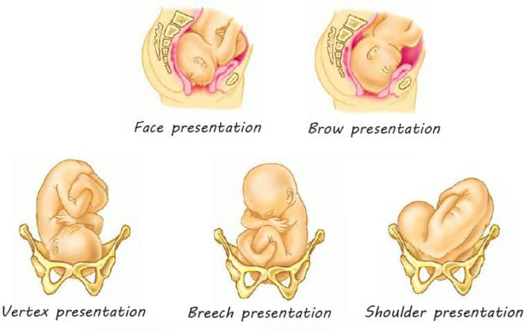 definition malpresentation fetus