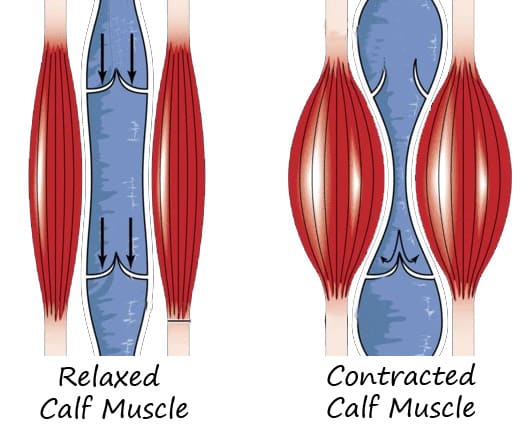 calf muscle pump (Varicose veins)